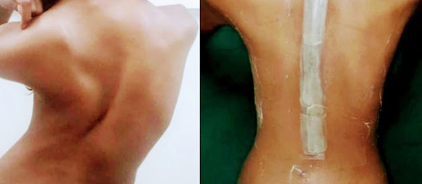 Doctor for Scoliosis surgery in Mumbai